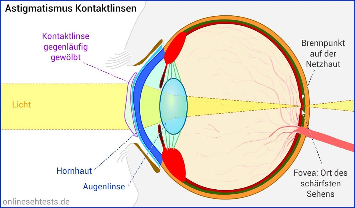 Astigmatismus, Hornhautverkrümmung Der GRONDE Blog erklärt
