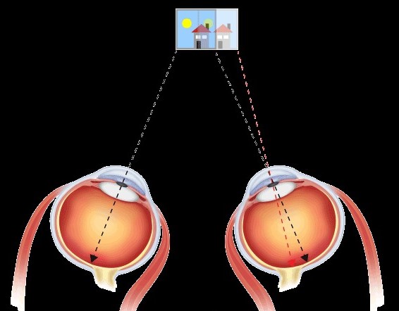Schielen oder Winkelfehlsichtigkeit im Sehtest bei Optiker Gronde, Bild2
